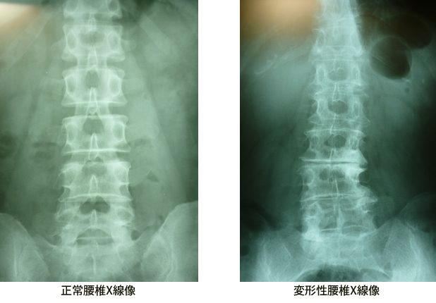 変形性腰椎X線像