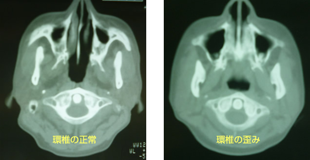 ストレートネック