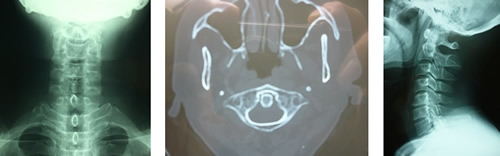 ストレートネック