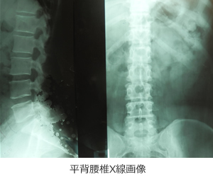 平背腰椎X線画像