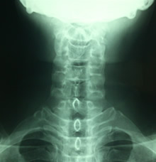 ストレートネック